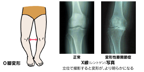草津　変形性膝関節症　
